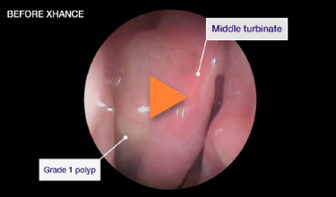 Video of patient 3 - improvement in SNOT-22 score